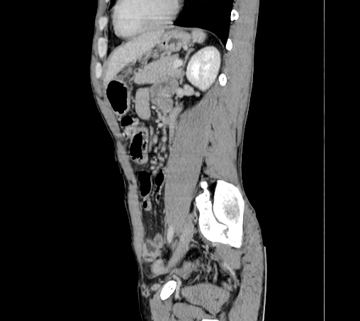 File:Bronchiectasis in Crohn disease (Radiopaedia 60311-67977 D 76).jpg