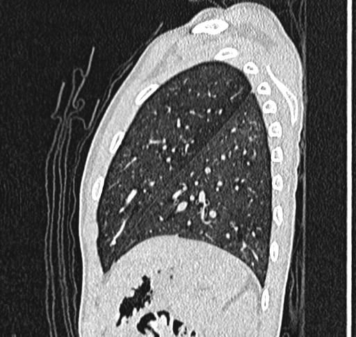 File:Bronchiolitis obliterans (Radiopaedia 71538-81897 Sagittal lung window 56).jpg