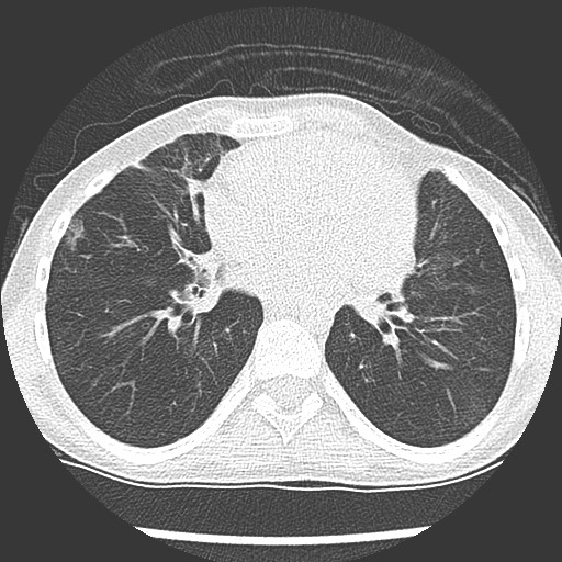 Bronchiolotis obliterans (Radiopaedia 73769-84575 Axial lung window 28).jpg