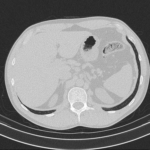 Bronchocele (Radiopaedia 60676-68429 Axial lung window 72).jpg