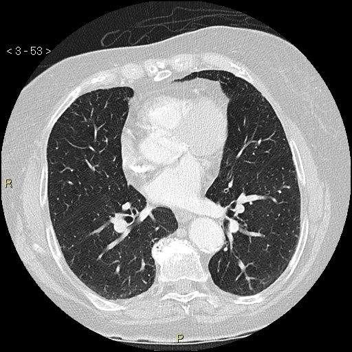 File:Bronchogenic carcinoma as an incidental finding (Radiopaedia 16453-16130 Axial lung window 53).jpg