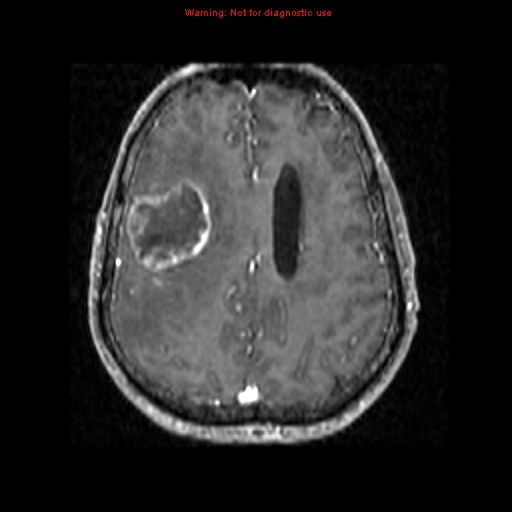 File:Bronchogenic carcinoma brain metastasis (Radiopaedia 9286-9969 Axial T1 C+ 14).jpg