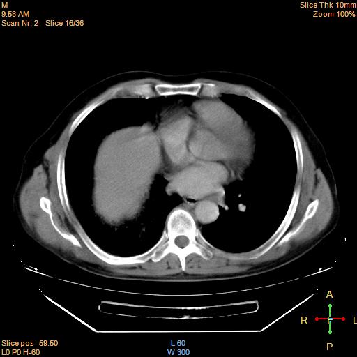 File:Bronchogenic carcinoma with superior vena caval invasion (Radiopaedia 22378-22406 Axial liver window 14).jpg