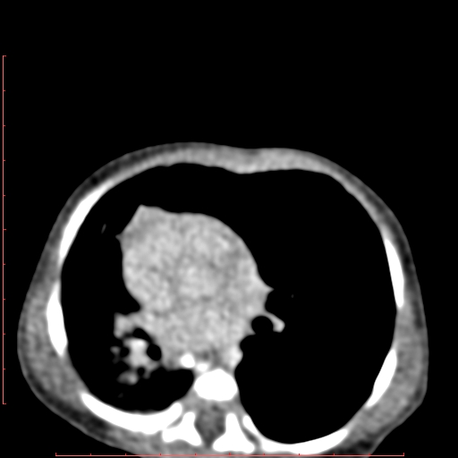 Bronchogenic cyst (Radiopaedia 78599-91409 B 110).jpg