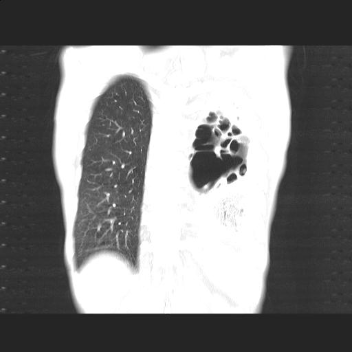 File:Bronchopleural fistula secondary to tuberculosis (Radiopaedia 20415-20322 Coronal lung window 19).jpg