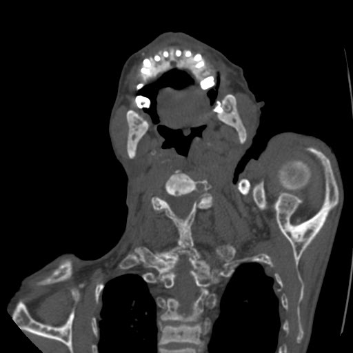 File:Brown tumor with secondary hyperparathyroidism (Radiopaedia 23591-23705 C 21).jpg
