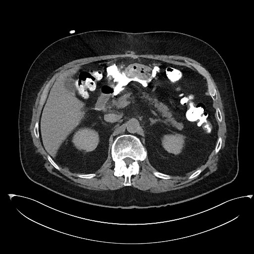Buried bumper syndrome - gastrostomy tube (Radiopaedia 63843-72577 Axial Inject 31).jpg