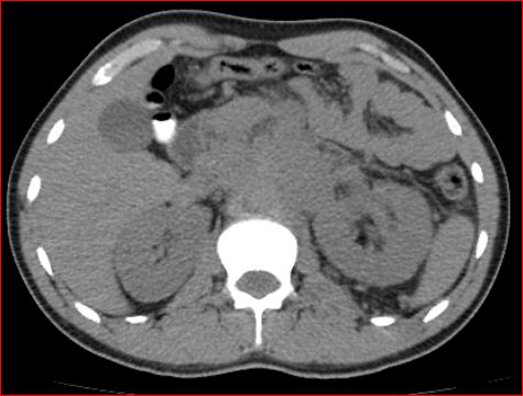 File:Burned-out testicular choriocarcinoma (Radiopaedia 32822-34040 Axial non-contrast 6).jpg