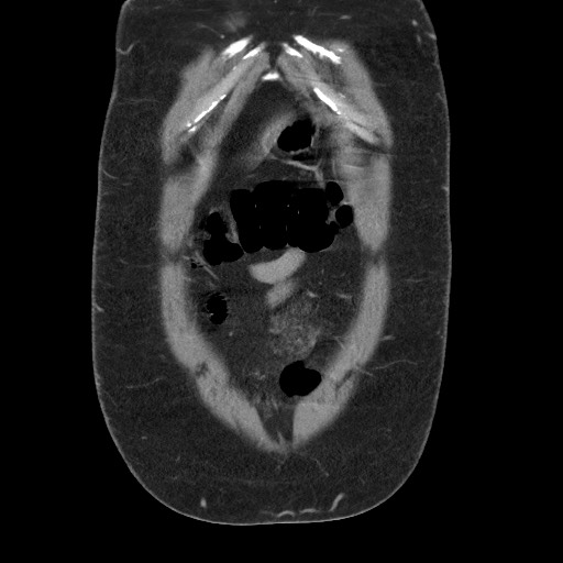 Burned-out testicular seminoma - retroperitoneal nodal metastases (Radiopaedia 62872-71245 B 10).jpg