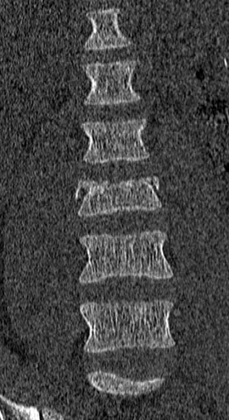 Burst fracture (Radiopaedia 53373-59357 Coronal bone window 17).jpg