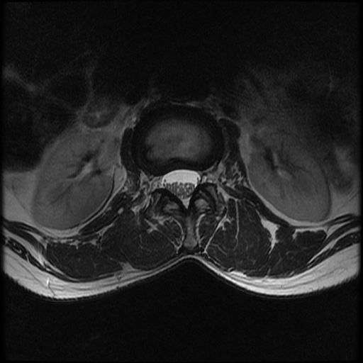File:Burst fracture - lumbar spine (Radiopaedia 72877-83541 Axial T2 4).jpg