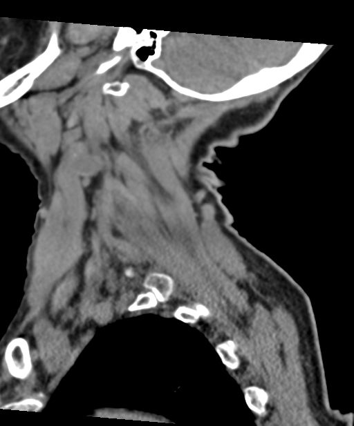 C2 fracture with vertebral artery dissection (Radiopaedia 37378-39199 D 17).png