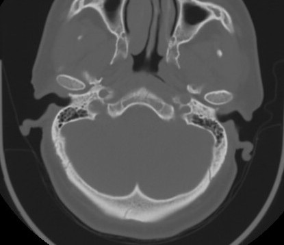 File:C7 laminar fracture and Klippel-Feil syndrome (Radiopaedia 86710-102850 Axial bone window 15).jpg