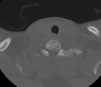 C7 laminar fracture and Klippel-Feil syndrome (Radiopaedia 86710-102850 Axial bone window 61).jpg