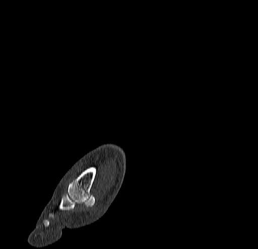 File:Calcaneal fracture - Sanders type 4 (Radiopaedia 90179-107370 Sagittal bone window 14).jpg