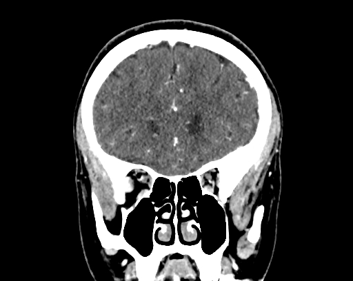Calcified cerebral hydatid cyst (Radiopaedia 65603-74717 C 18).jpg