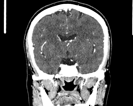 File:Calcified cerebral hydatid cyst (Radiopaedia 65603-74717 C 33).jpg