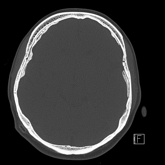 Calcified chronic subdural hematoma (Radiopaedia 77374-89492 Axial bone window 54).jpg