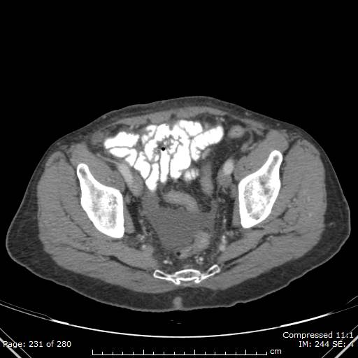 Calcified liver metastases (Radiopaedia 44699-48470 B 53).jpg