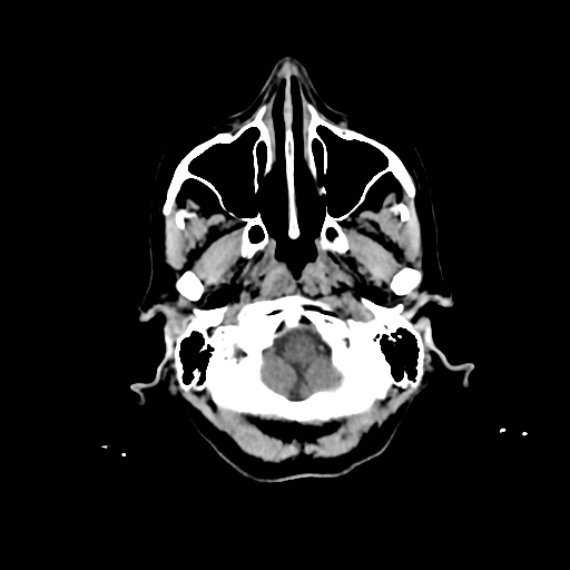 File:Calcified meningioma - cervical canal (Radiopaedia 70136-80171 Axial non-contrast 4).jpg