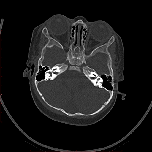 Calcified middle cerebral artery embolism (Radiopaedia 78949-91860 Axial bone window 6).jpg