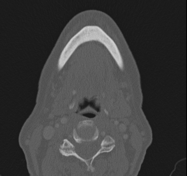 Caldwell-Luc operation (Radiopaedia 52329-58225 Axial bone window 68).jpg