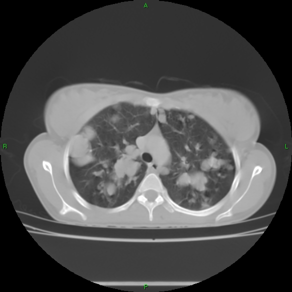 File:Cannon ball metastases - synovial sarcoma (Radiopaedia 26135-26271 Axial lung window 12).jpg