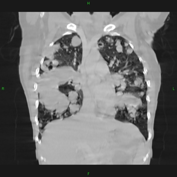 File:Cannon ball metastases - synovial sarcoma (Radiopaedia 26135-26271 Coronal lung window 6).jpg
