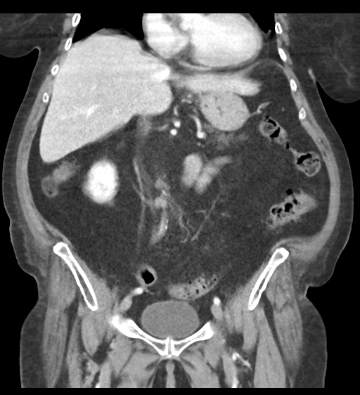 Cannonball metastases from endometrial cancer (Radiopaedia 42003-45031 F 34).png
