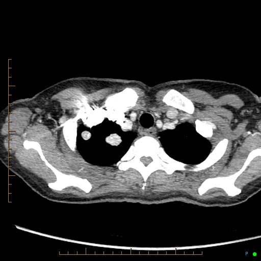 Canonball lung metastasis (Radiopaedia 77634-89837 B 8).jpg