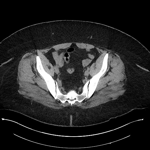 File:Carcinoid tumor - terminal ileum (Radiopaedia 60931-68740 Axial non-contrast 98).jpg