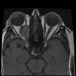 File:Carcinoid tumor of the ileum with metastasis to orbit (Radiopaedia 28165-28424 Axial T1 4).jpg
