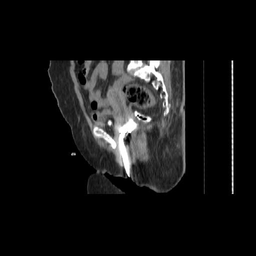 File:Carcinoma cervix- brachytherapy applicator (Radiopaedia 33135-34173 D 75).jpg