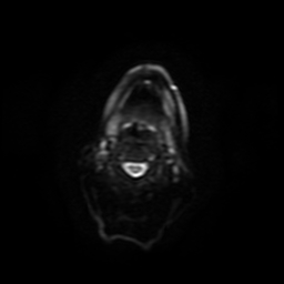 Carcinoma ex-pleomorphic adenoma of parotid (Radiopaedia 28383-28627 Ax DWI B-500 GE 8).jpg