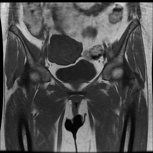 File:Carcinoma of the cervix (Radiopaedia 89018-105858 Coronal T1 5).jpg