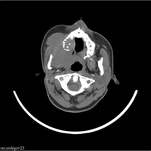 File:Carcinoma of the maxillary antrum (Radiopaedia 53805-59888 Axial non-contrast 53).jpg