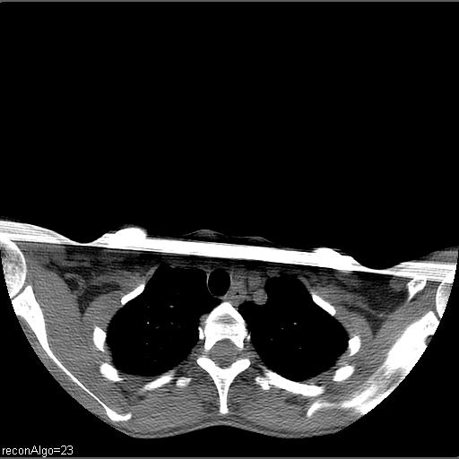 Carcinoma of the maxillary antrum (Radiopaedia 53805-59888 Axial non-contrast 82).jpg