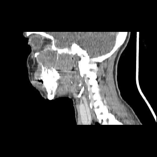 Carcinoma of the maxillary antrum (Radiopaedia 53805-59888 Sagittal C+ delayed 73).jpg