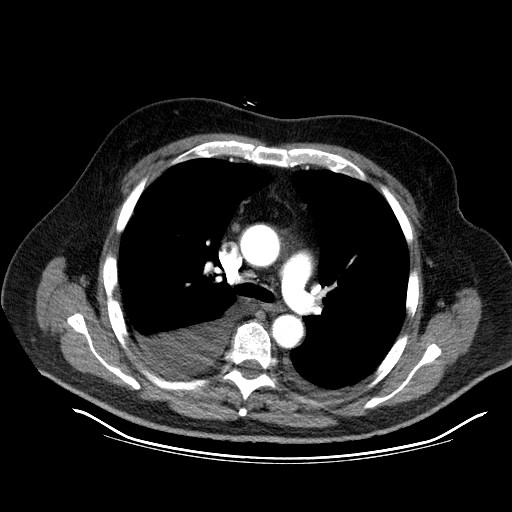 File:Cardiac lymphoma (Radiopaedia 38690-40836 Axial C+ CTPA 5).jpg