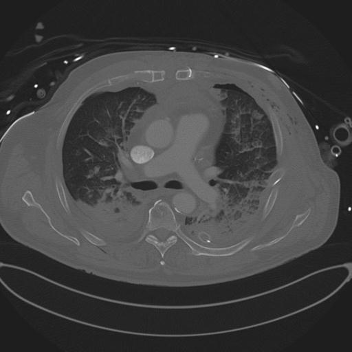 Cardiac trauma (Radiopaedia 32874-33858 Axial bone window 38).jpg