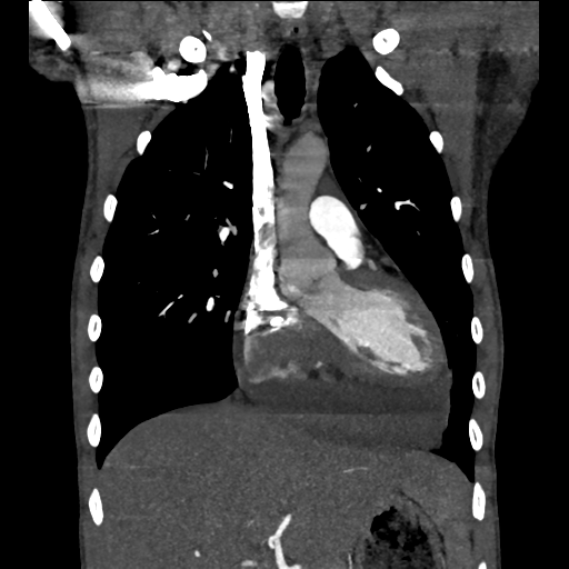 Cardiac tumor - undifferentiated pleomorphic sarcoma (Radiopaedia 45844-50134 Coronal non-contrast 26).png