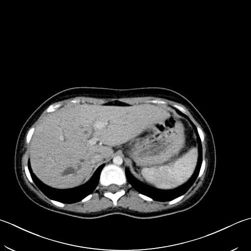 File:Caroli disease with medullary sponge kidney (Radiopaedia 82622-96804 C 18).jpg