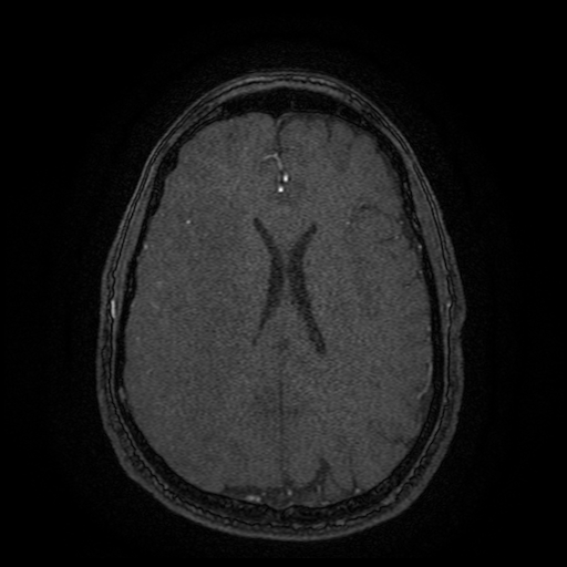 File:Carotid arterial dissection with acute cerebral infarction (Radiopaedia 26636-26784 MRA 49).jpg