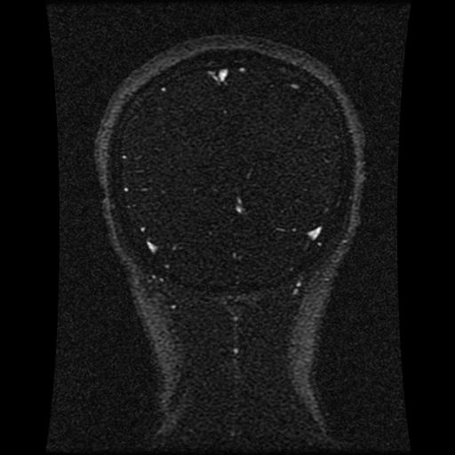 Carotid arterial dissection with acute cerebral infarction (Radiopaedia 26636-26784 MRV 55).jpg
