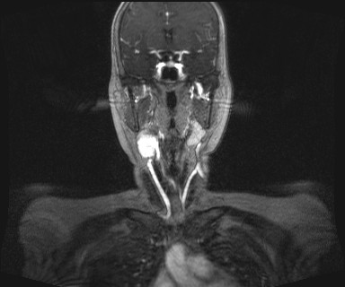 Carotid body tumor (Radiopaedia 12777-12912 MRA 23).jpg