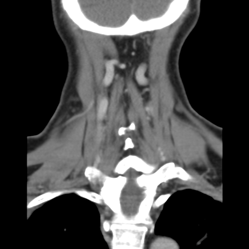 File:Carotid body tumor (paraganglioma) (Radiopaedia 38586-40729 B 35).jpg
