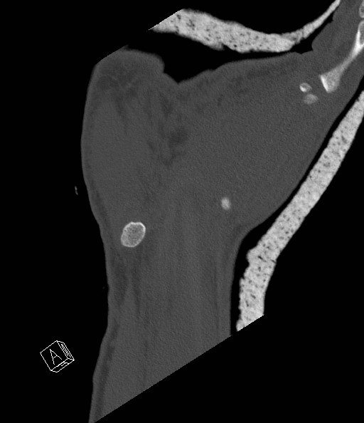 File:Carpal fractures (smart watch impaction) (Radiopaedia 55844-62430 Coronal bone window 24).jpg
