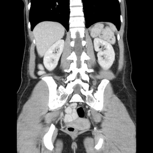 Castleman disease with fibrous pseudotumor in the abdomen (Radiopaedia 77296-89373 B 68).jpg