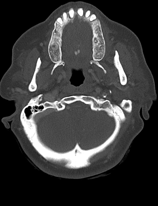 Causes of dysphagia (Radiopaedia 40149-42657 Axial bone window 12).png