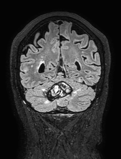 Cavernous hemangioma of the cerebellar falx (Radiopaedia 73025-83724 Coronal FLAIR 265).jpg